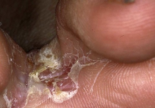 Everything You Need to Know About Fungal Infections