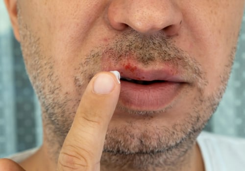 Antibiotic Creams and Ointments for Oral Herpes Treatment